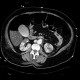 Renal infarction, biliary excretion of contrast: CT - Computed tomography